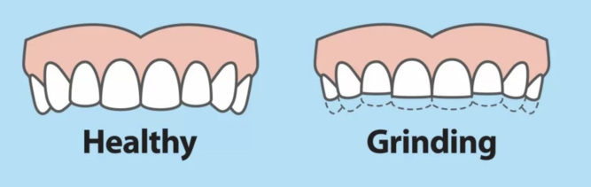 example of healthy teeth vs teeth that have been worn by bruxism
