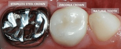 Comparing stainless steel crown to a zirconia crown to a natural tooth